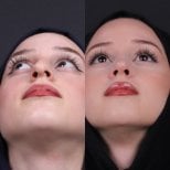 Before and after rhinoplasty results, nose reshaping with improved nasal symmetry