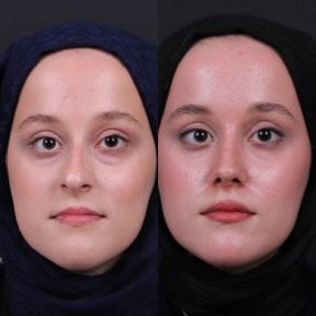 Before and after rhinoplasty results, nose reshaping for improved facial harmony