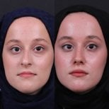 Before and after rhinoplasty results, nose reshaping for improved facial harmony