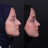Before and after rhinoplasty results, nose reshaping for improved profile and symmetry