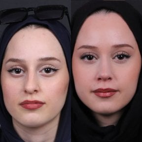 Before and after rhinoplasty results, improved nose shape and symmetry for female patient