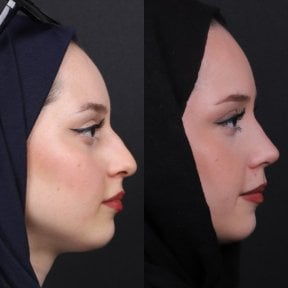 Before and after rhinoplasty results, nose reshaping with natural profile improvement