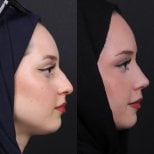 Before and after rhinoplasty results, nose reshaping with natural profile improvement