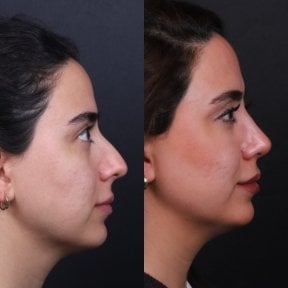 Before and after rhinoplasty results, nose reshaping for improved profile and symmetry