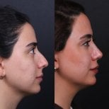 Before and after rhinoplasty results, nose reshaping for improved profile and symmetry