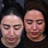 Before and after rhinoplasty results, nose reshaping with natural look improvement