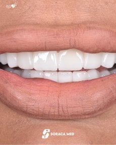 before-after photo zirconia-crown-installation