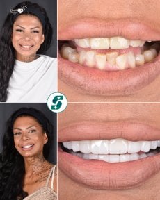 before-after photo zirconia-crown-installation