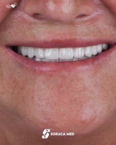 before-after photo dental-crown-installation