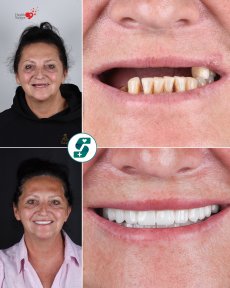 before-after photo dental-crown-installation