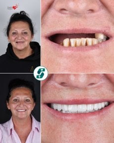 Before and after dental implant results at Soraca Med – restored smile and improved teeth