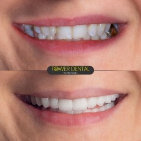 before-after photo emax-veneers