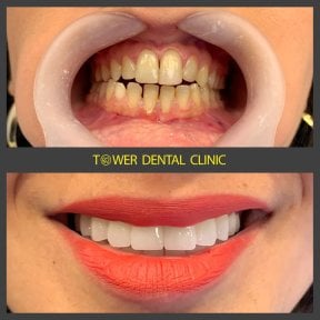 before-after photo emax-veneers