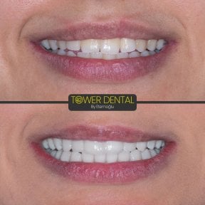 before-after photo emax-veneers