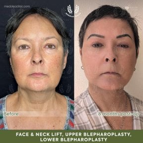 before-after photo deep-plane-facelift