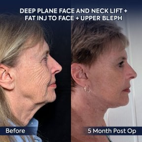before-after photo deep-plane-facelift
