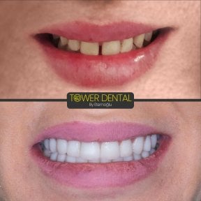 before-after photo emax-veneers