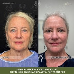 before-after photo deep-plane-facelift