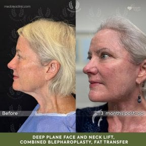 before-after photo deep-plane-facelift