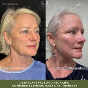before-after photo deep-plane-facelift