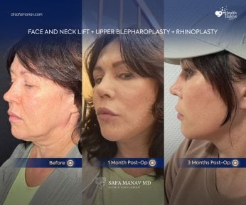 before-after photo deep-plane-facelift