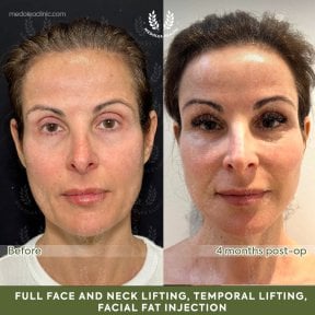 before-after photo deep-plane-facelift