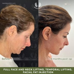 before-after photo deep-plane-facelift