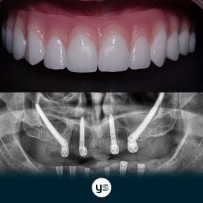 Результат установки скулових All-on-4 імплантів у YeahSmile – посмішка та рентген