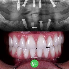 Результат до та після установки скулових All-on-4 імплантів у клініці YeahSmile