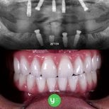 Результат до та після установки скулових All-on-4 імплантів у клініці YeahSmile