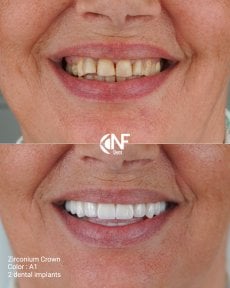 before-after photo flapless-all-on-4-implant-surgery