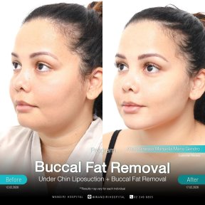 before-after photo buccal-fat-extraction
