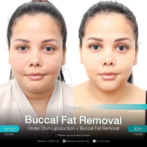 before-after photo buccal-fat-extraction