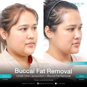 before-after photo buccal-fat-extraction