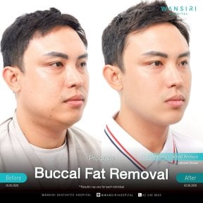 before-after photo buccal-fat-extraction