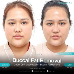 before-after photo buccal-fat-extraction
