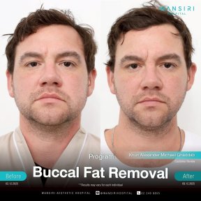 before-after photo buccal-fat-extraction