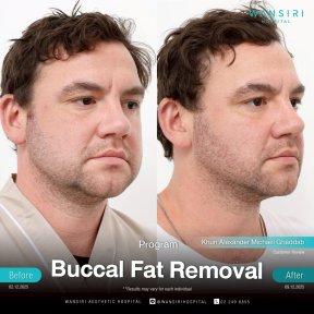 before-after photo buccal-fat-extraction