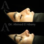 Resultados de rinoplastia antes y después en PyraMedicine, perfil nasal natural