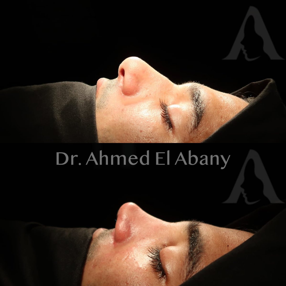 نتائج تجميل الأنف قبل وبعد في PyraMedicine، تحسين شكل ومحيط الأنف