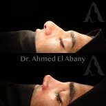 نتائج تجميل الأنف قبل وبعد في PyraMedicine، تحسين شكل ومحيط الأنف