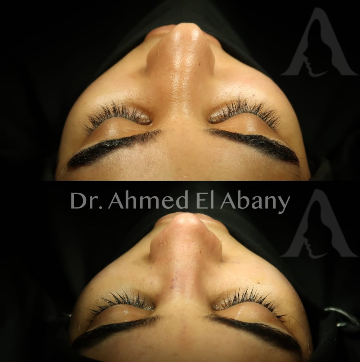 Resultados de rinoplastia antes y después en PyraMedicine, remodelación nasal natural