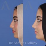 نتائج عملية تجميل الأنف قبل وبعد في PyraMedicine، إعادة تشكيل الأنف بمظهر طبيعي