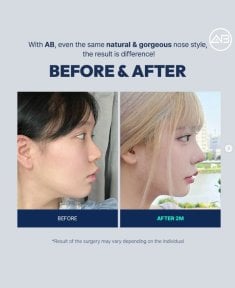 Resultados antes y después de rinoplastia secundaria en AB Plastic Surgery, perfil nasal mejorado