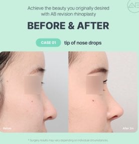 Antes y después de rinoplastia de revisión en AB Plastic Surgery, punta de nariz mejorada