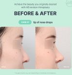 Antes y después de rinoplastia de revisión en AB Plastic Surgery, punta de nariz mejorada