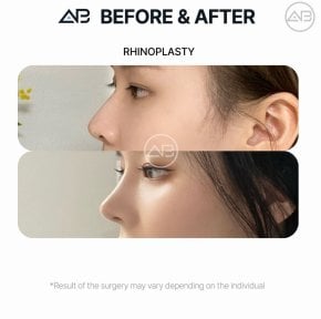 Resultados de rinoplastia antes y después en AB Plastic Surgery, mejora visible de la nariz
