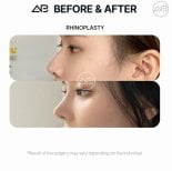 Resultados de rinoplastia antes y después en AB Plastic Surgery, mejora visible de la nariz