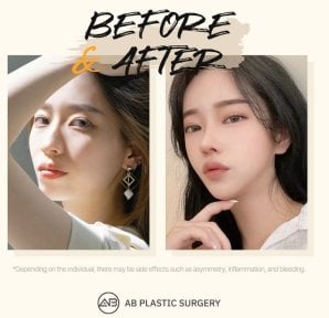 Resultados antes y después de rinoplastia secundaria en AB Plastic Surgery, nariz refinada