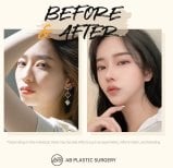 Resultados antes y después de rinoplastia secundaria en AB Plastic Surgery, nariz refinada